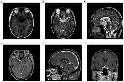 Clinical features of pituitary carcinoma: analysis based on a case report and literature review